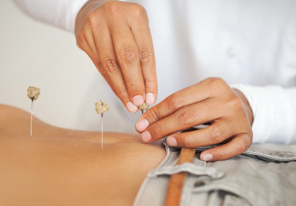 Acupuncture