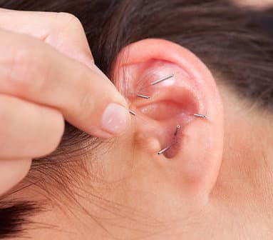 Acupuncture