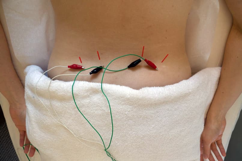 Acupuncture