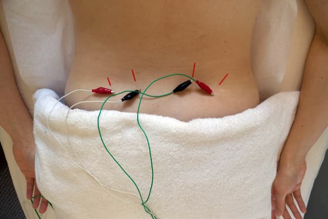 WHY CHOOSE ACUPUNCTURE TREATMENTS?